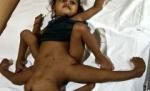 Un copil cu opt membre s-a născut în Nepal

