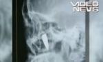 A trăit peste 40 de ani cu un glonţ în cap (VIDEO)
