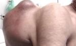 Tumoră gigant, crescută în cinci luni pe spatele unui bătrân din Iaşi (VIDEO)