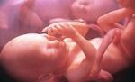 Tată pe jumătate: A aflat că numai unul din gemeni e copilul lui biologic