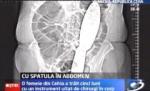A stat 5 luni cu o spatulă în abdomen (VIDEO)