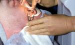 Un vierme de aproape zece centimetri a fost scos din ochiul unui bărbat (VIDEO)