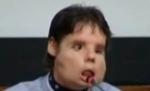 Spaniolul supus primului transplant total de faţă şi-a făcut apariţia în public (VIDEO)