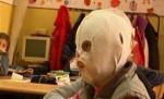 O fetiţă de 10 ani cu faţa arsă trebuie să poarte o mască de plastic tot timpul