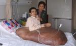 Tumoare de 90 kg şi diametrul de un metru. Bărbatul va fi operat astăzi