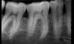 Radiografiile dentare cresc riscul dezvoltării tumorilor cerebrale