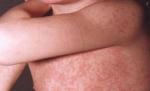 Epidemie de rubeolă în ţară. La Sibiu, s-au înregistrat de 30 de ori mai multe cazuri decât anul trecut