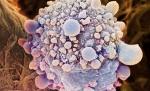 Extinderea cancerului pancreatic poate fi stopată: O genă inactivă, cheia întregului proces