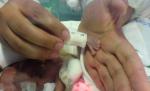 S-a agăţat de viaţă cu toate puterile. O fetiţă care cântărea 340 de grame, salvată de medicii brazilieni