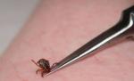 Căpuşele creează panică generală. 400 de oameni au fost înţepaţi de aceste insecte, numai la Sibiu