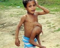Un băiat de 8 ani din India trăieşte cu membrele fratelui geamăn în piept (IMAGINI ŞOCANTE)