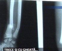 Copil trimis să trateze o entorsă cu gheaţă deşi în fişa medicală i s-a scris că avea nevoie de ghips