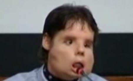 Spaniolul supus primului transplant total de faţă şi-a făcut apariţia în public (VIDEO)