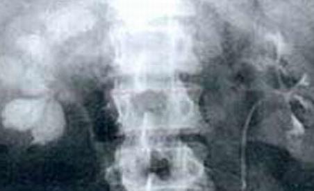 Cercetătorii au dezvoltat un test care poate depista tuberculoza în maximum două ore