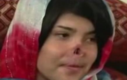 Afganistan. O tânără a primit un nas nou, după ce soţul i l-a tăiat pe cel natural (VIDEO)