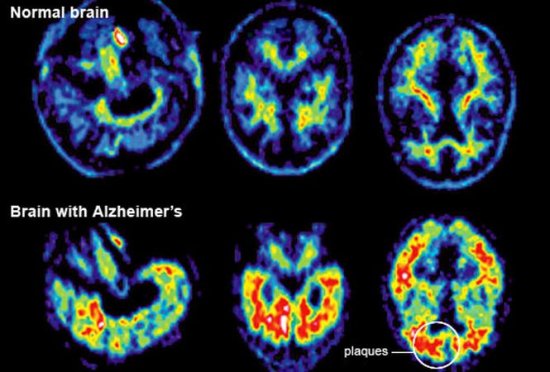 Descoperire remarcabilă. Testul care detectează riscul de apariţie a bolii Alzheimer 407