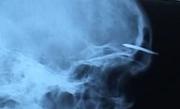 Un deţinut şi-a bătut un cui în cap, nemulţumit de traiul din penitenciar