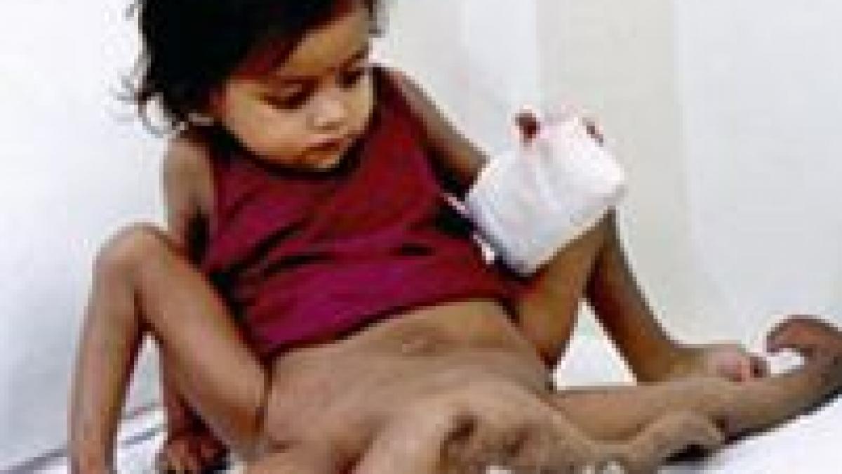 fetita cu patru maini si patru picioare a fost operata cu succes video si galerie foto