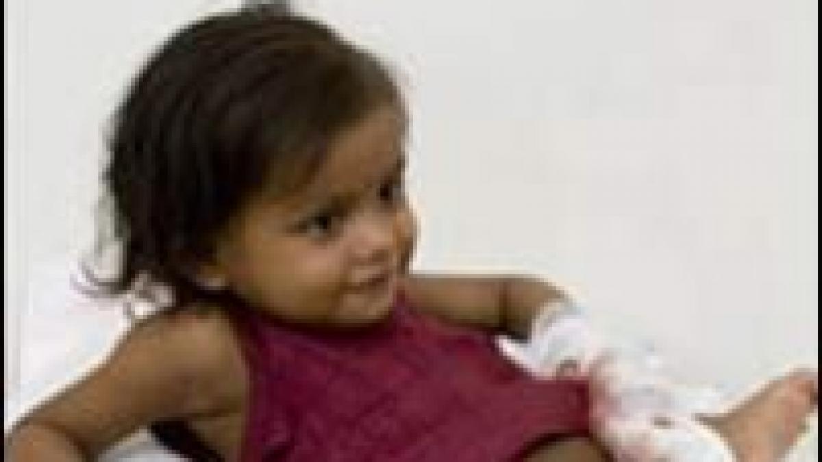 india urmatoarele 72 de ore critice pentru fetita cu opt membre