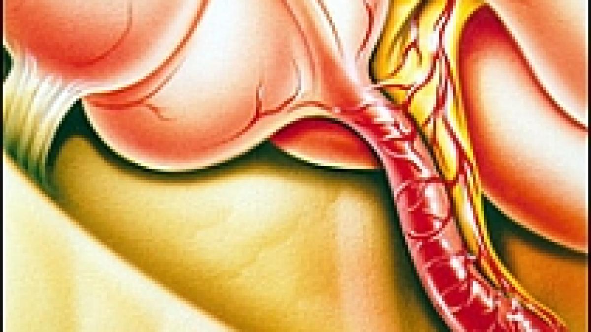 aerul poluat poate provoca apendicita