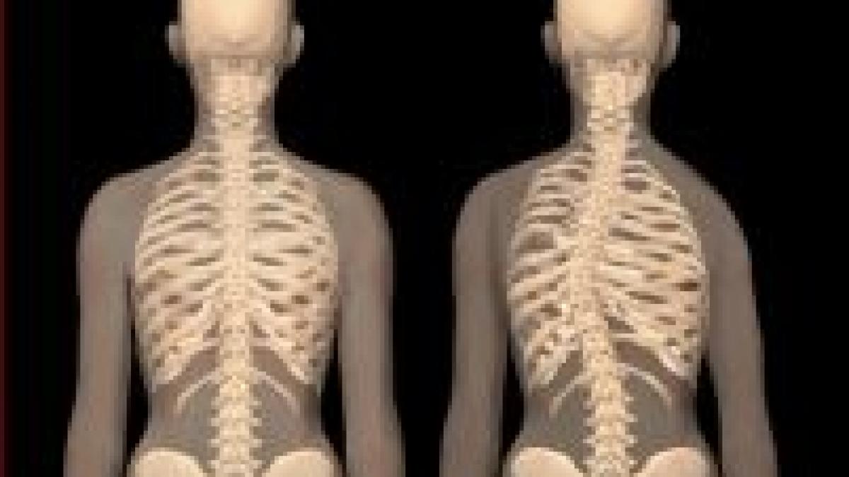 romania tara cu cei mai multi copii bolnavi de scolioza din europa