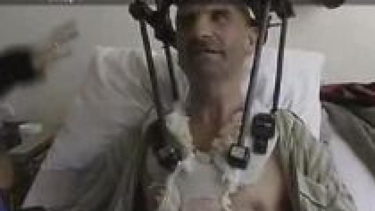 ploiesti pacientii care si au fracturat coloana pot evita operatia