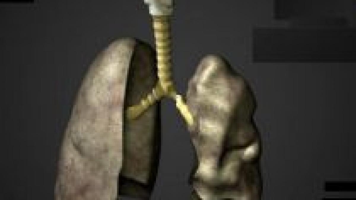 medicii spanioli au realizat primul transplant de trahee