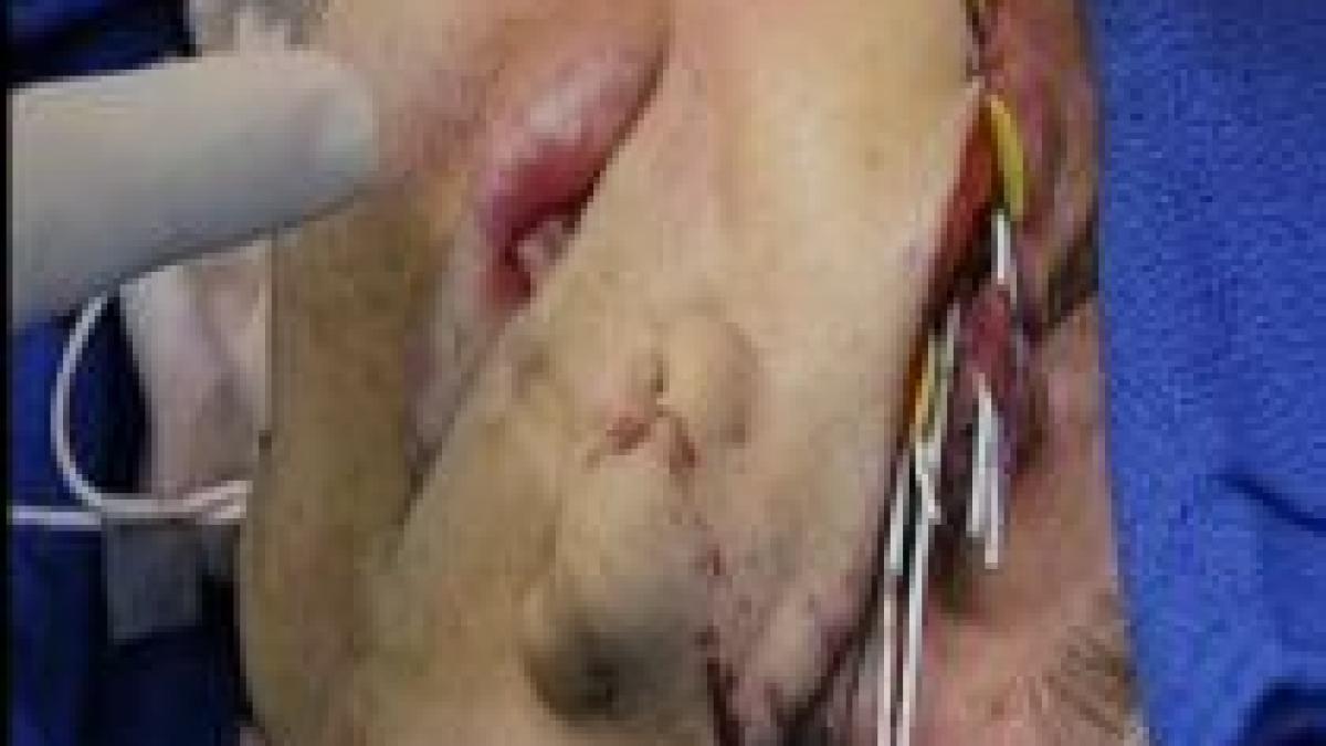 china medicii au reusit primul transplant facial complet imagini socante