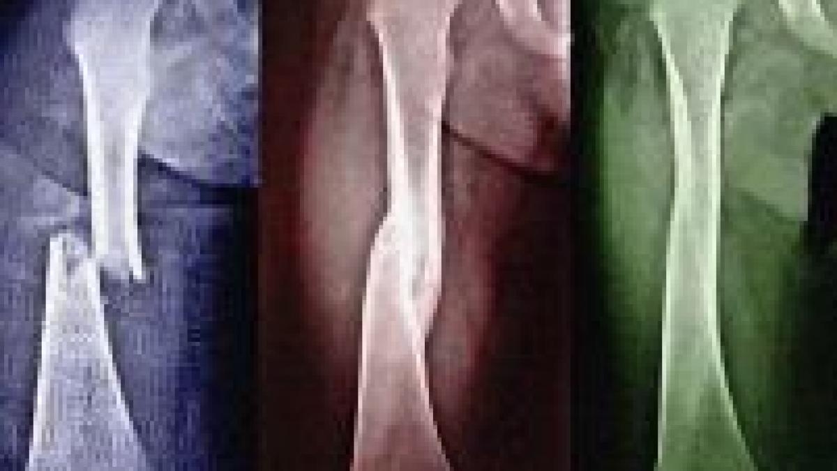 cercetatorii au creat un material care lipeste oasele fracturate