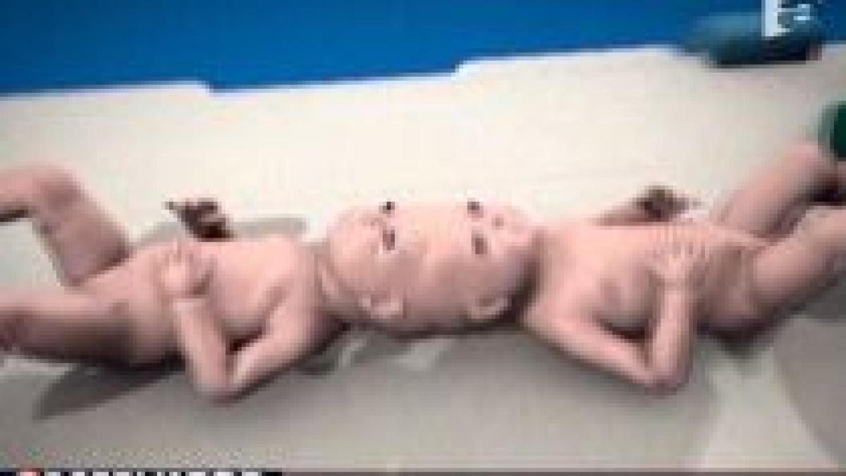 operatia de separare a siamezilor din brasov pusa sub semnul intrebarii