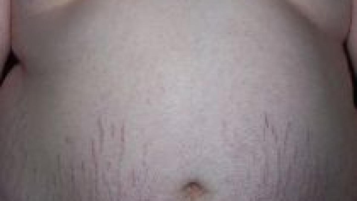 cum iti poate deconta statul tratamentul de slabit cu hartie de la medic