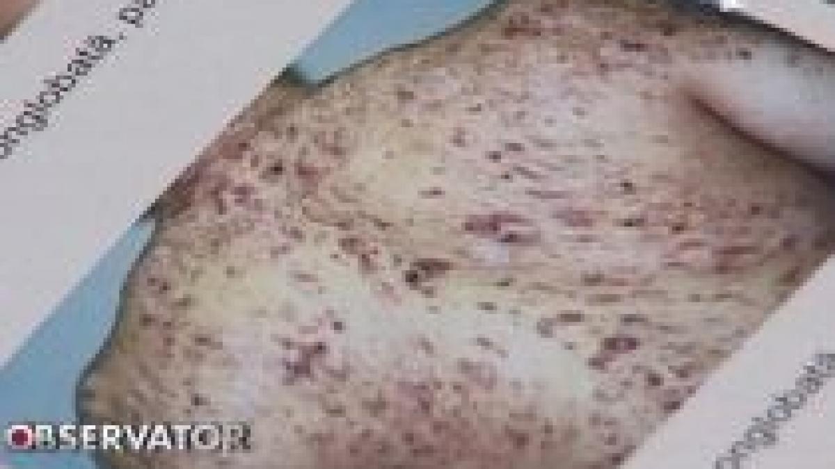 controverse legate de un medicament contra acneei sinuciderea printre efectele adverse