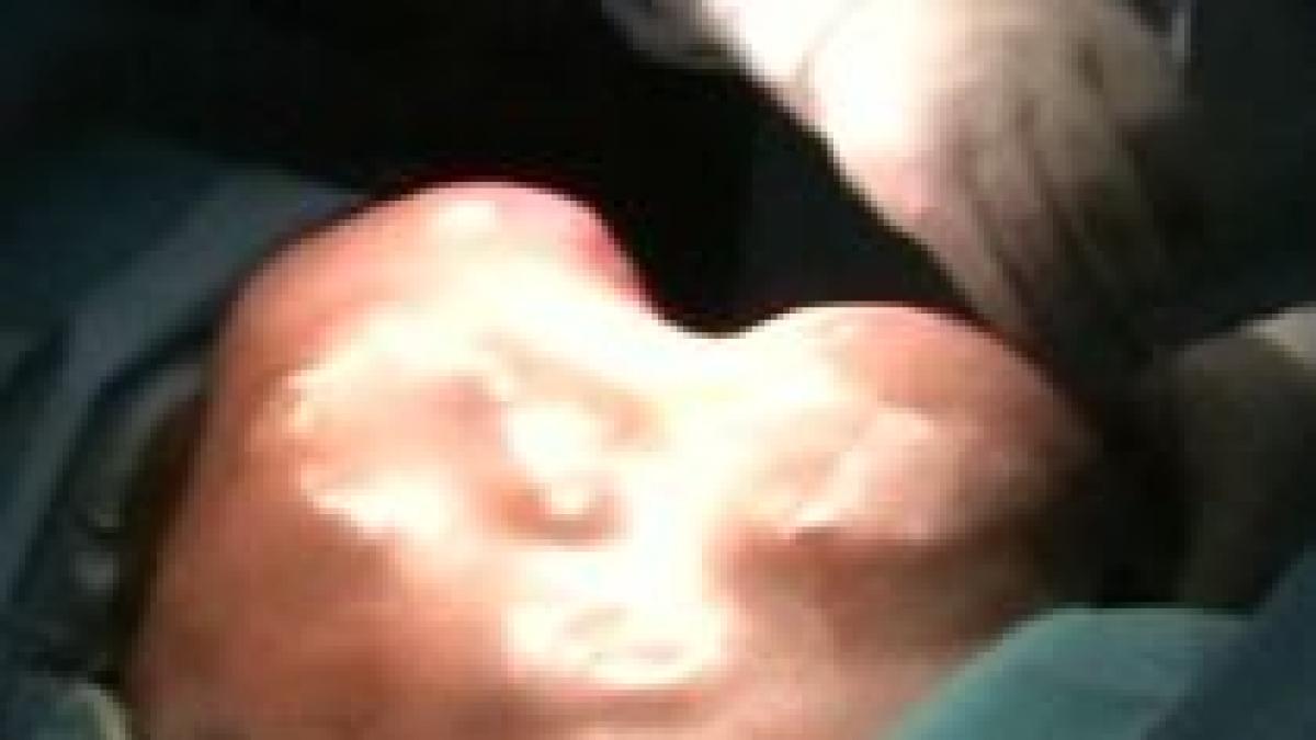 tumora gigant extirpata de la un pacient al spitalului militar din capitala imagini socante