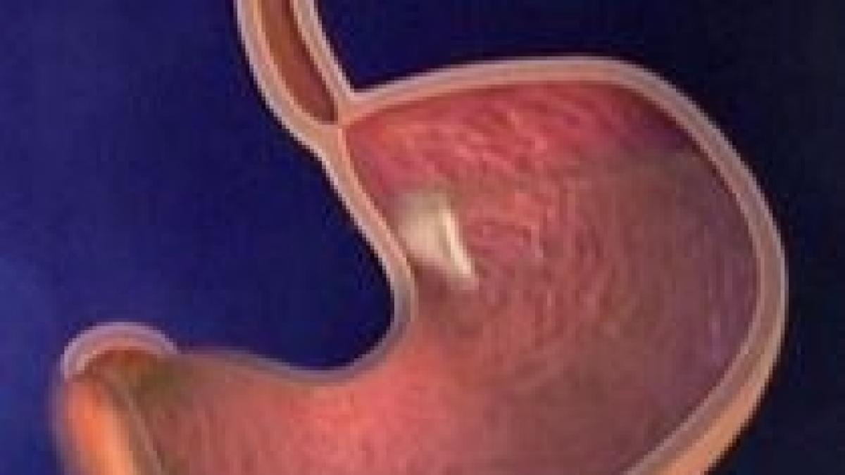 inelul sau balonul gastric solutiile pentru obezitatea morbida la care au apelat peste 1 000 de