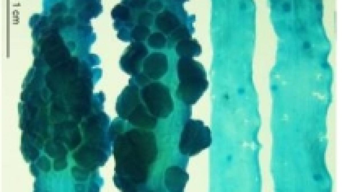bacteria care cauzeaza cancerul la colon identificata de cercetatorii americani