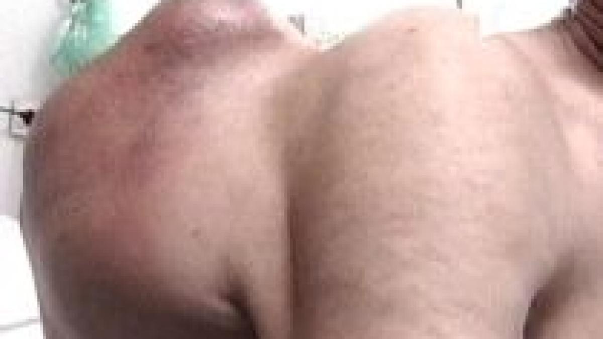 tumora gigant crescuta in cinci luni pe spatele unui batran din iasi video