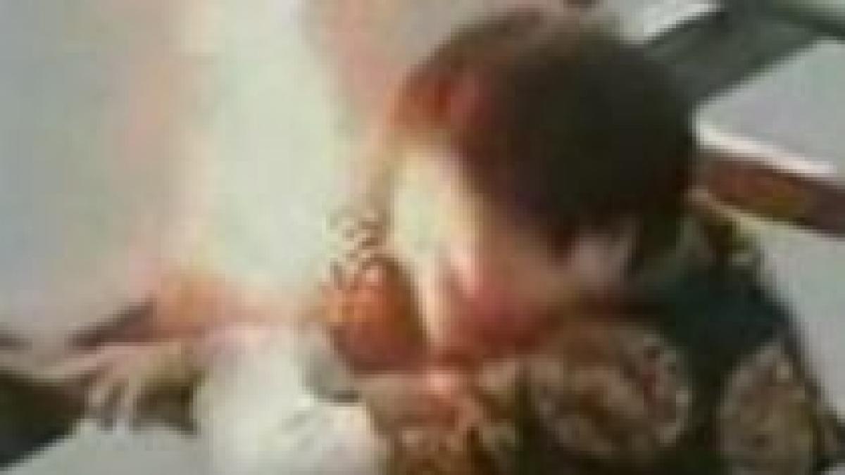 a supravietuit dupa ce s a electrocutat cu 10 000 de volti imagini socante