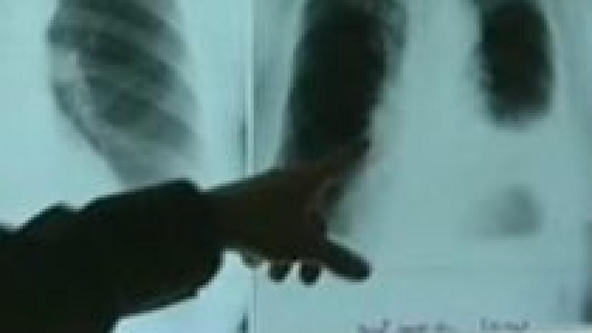 fumatorii mai sensibili la virusul ah1n1 afla ce complicatii letale poate avea gripa porcina video