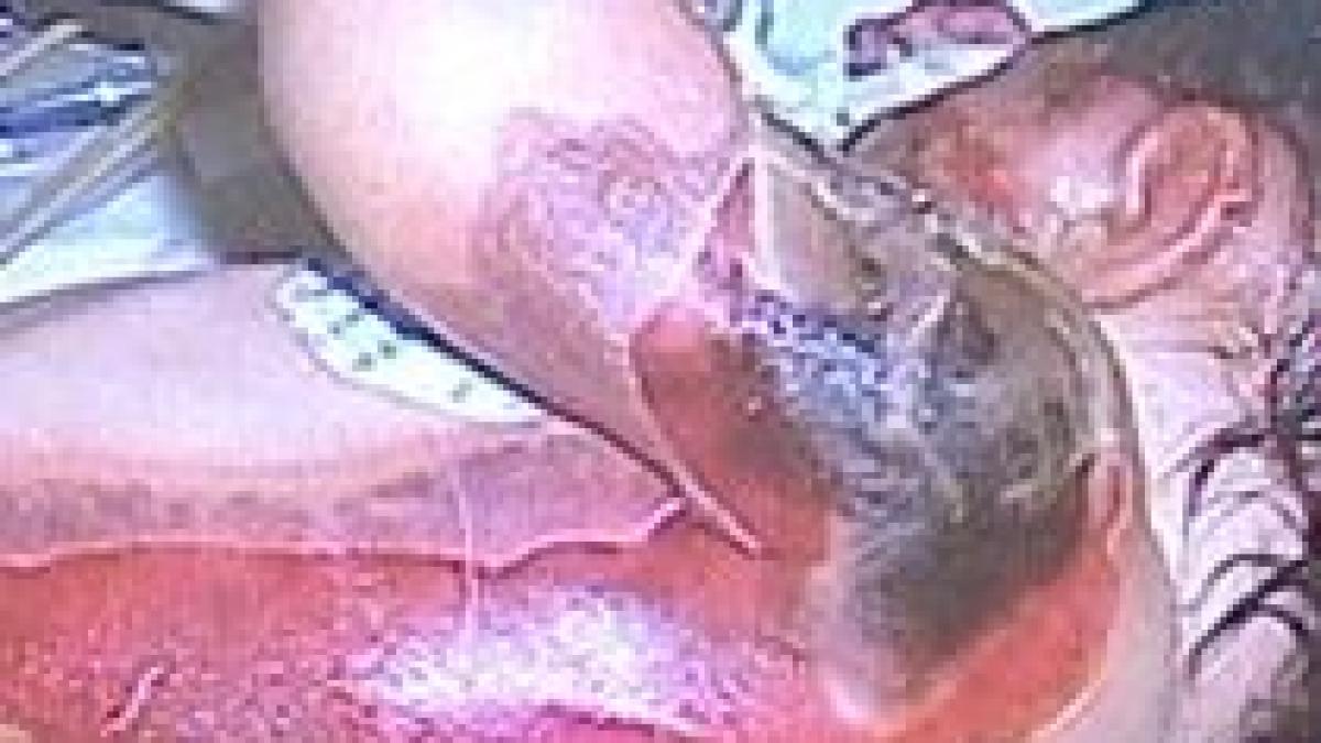 bebelusul uitat in incubator a fost operat dar sansele de supravietuire sunt mici imagini socante