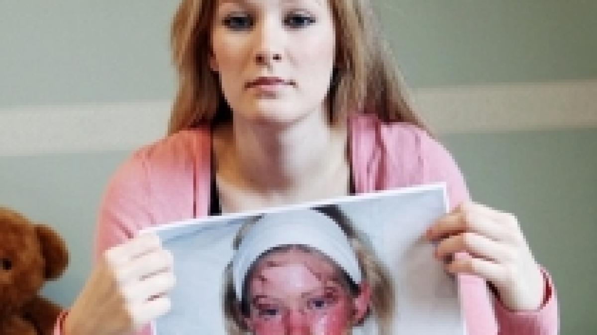 desfigurata de paracetamol o tanara a ajuns in stare grava la spital dupa ce a luat o pastila