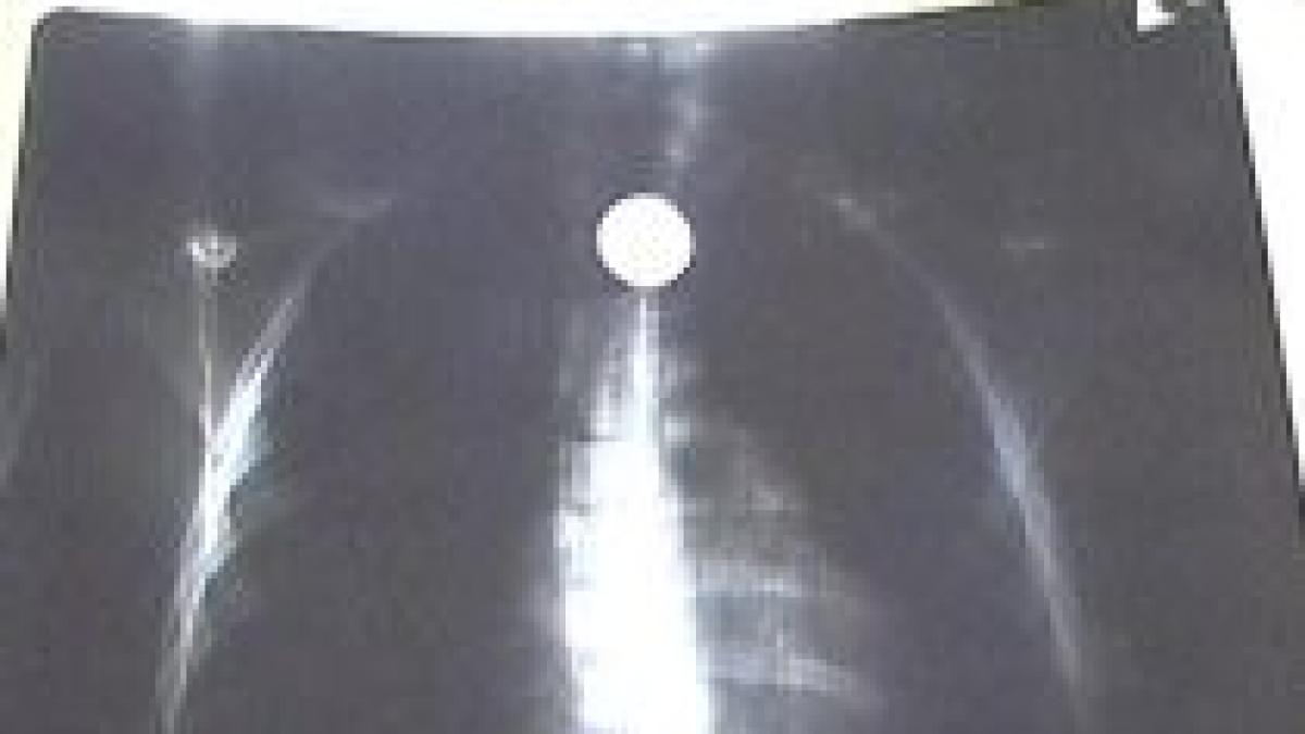 copil de 2 ani din oradea la un pas de moarte dupa ce a inghitit o moneda de 10 bani video