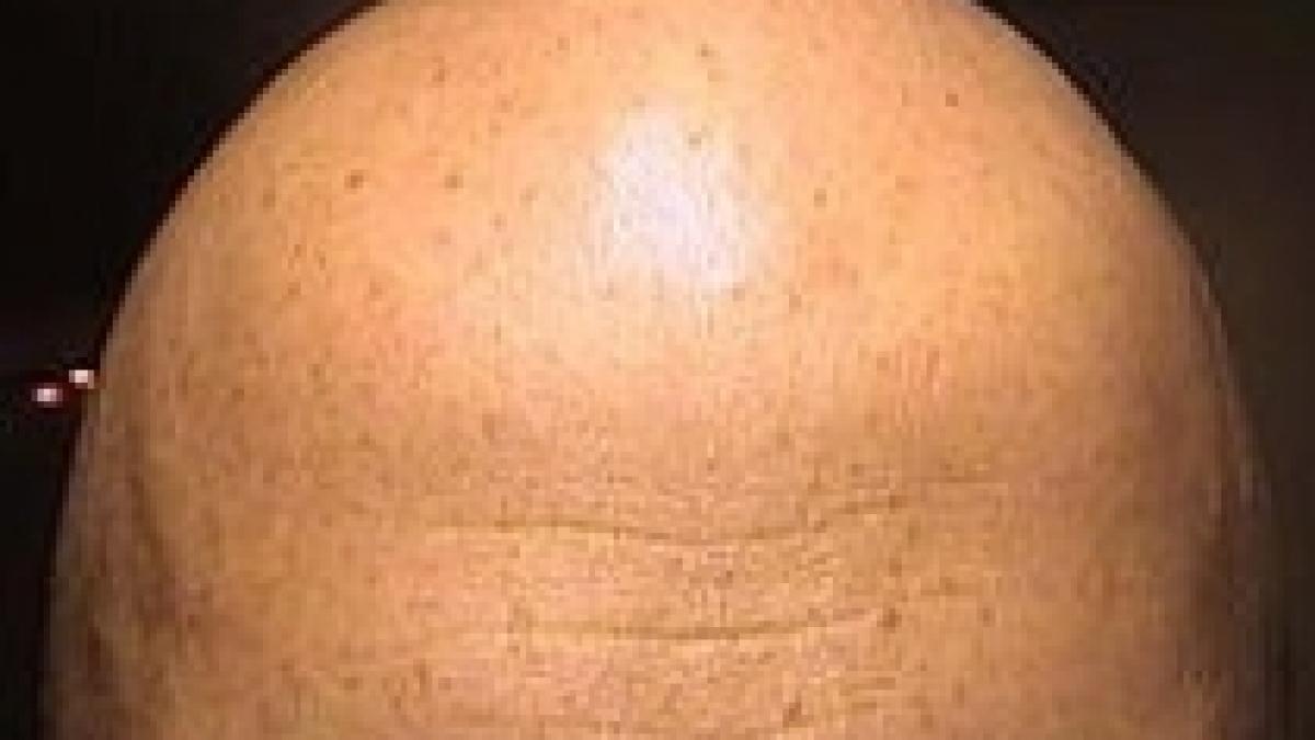 gena responsabila de caderea parului la barbati identificata de cercetatorii din sua