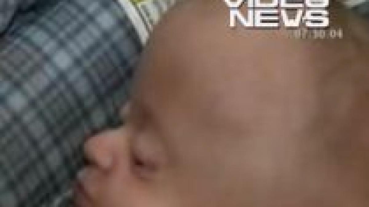 medicii au remodelat craniul unui bebelus care sufera de o boala genetica rara video