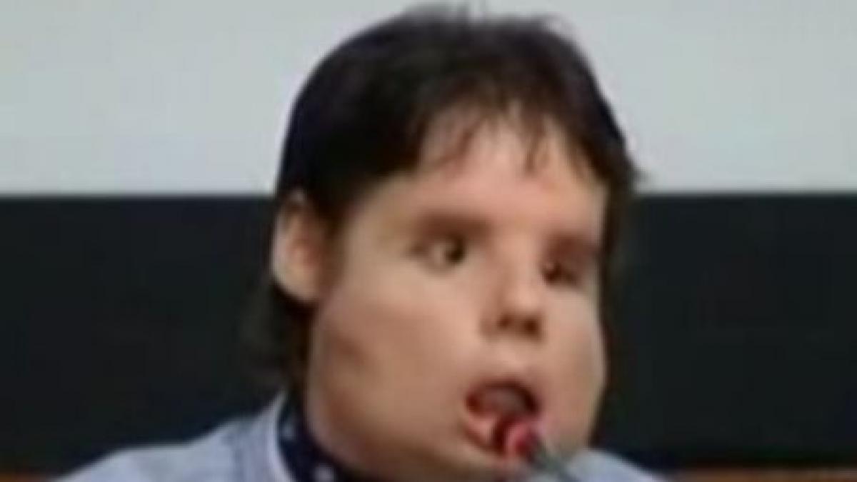 spaniolul supus primului transplant total de fata si a facut aparitia in public video