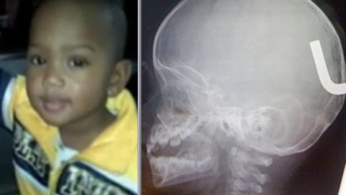 un baietel a supravietuit dupa ce o tija metalica i s a infipt in creier video