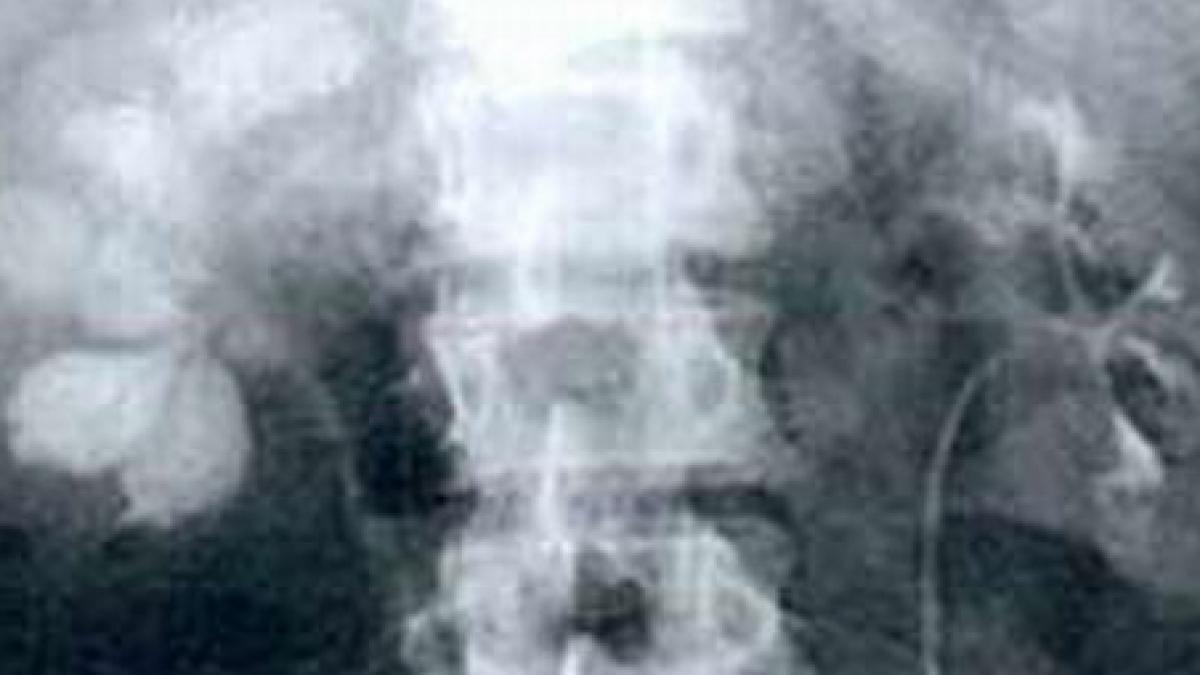 cercetatorii au dezvoltat un test care poate depista tuberculoza in maximum doua ore