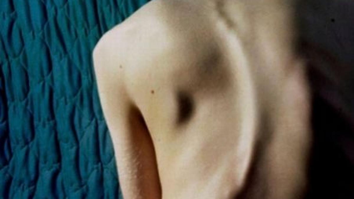 medicii de la grigore alexandrescu au operat cel mai grav caz de scolioza din lume