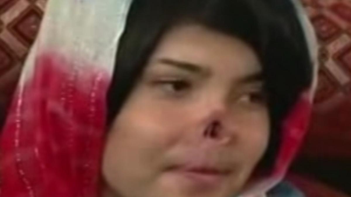 afganistan o tanara a primit un nas nou dupa ce sotul i l a taiat pe cel natural video