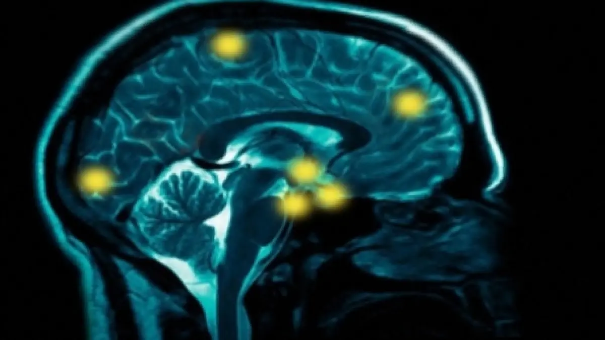 o importanta descoperire ar putea ajuta la tratarea a 130 de afectiuni inclusiv alzheimer
