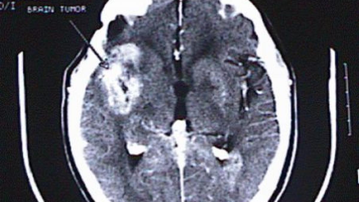 studiu cazurile de tumoare cerebrala s au inmultit de cinci ori in ultimii zece ani